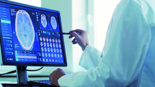 Une technique innovante pour traiter l’épilepsie et certaines lésions cérébrales